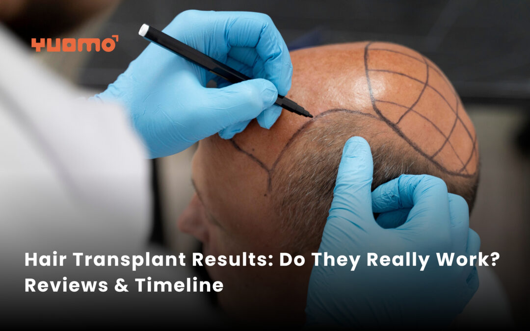 Hair Transplant Before & After: The Real Timeline, Results & What Nobody Tells You